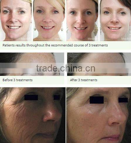 Amazing Results Skin Needling Derma Rolling solution