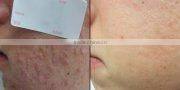 professional red led light mask led light therapy skin tightening machine
