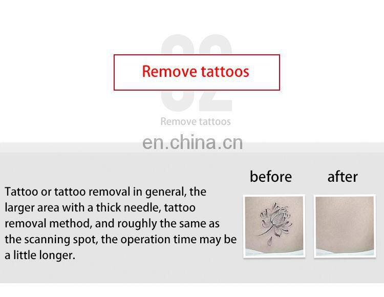 Handhold Skin Care Product Laser Mole Removal Pen Spot Removal Plasma Pen