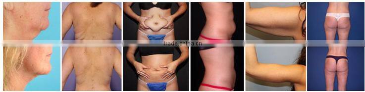 5 in 1 lost weight explosive speed grease cavitation slimming system