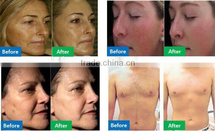 permanent ipl shr hair removal machine with opt system hair removal and skin reguventation