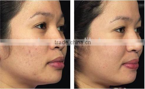 2016 hot selling permanent hair removal beauty equipment IPL machine for skin rejuvenation anti aging wrinkle removal