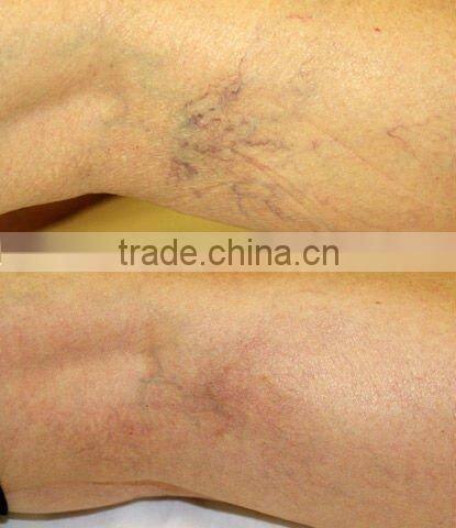 surgery laser instrument laser hair remover P003