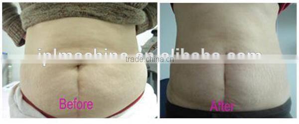 HOTTEST kim 8 new cavitation rf vacuum slimming machine