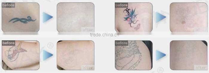 Hottest factory price!! laser tattoo removal q switched keyword:nd yag laser