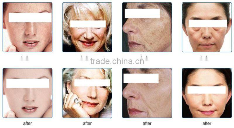 high quality/ light/led pdt yellow light skin rejuvenation beauty device