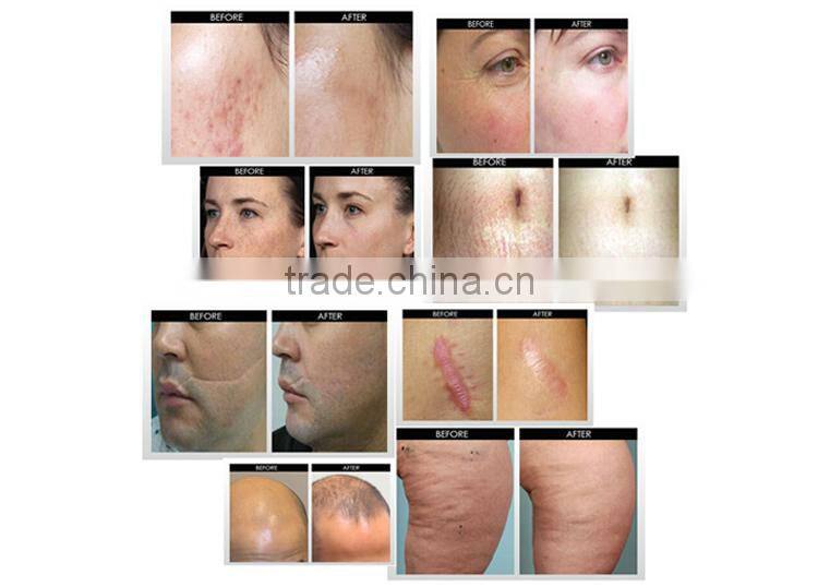 Dermapen micro needling with cartridge