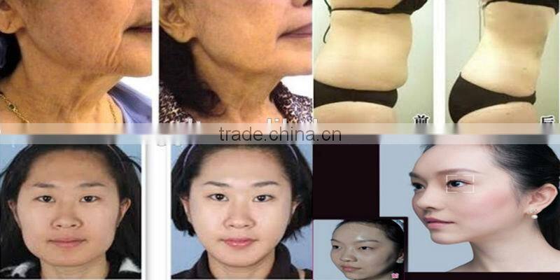 face lift skin rejuvenation pigment correcting RF slimming beauty machine