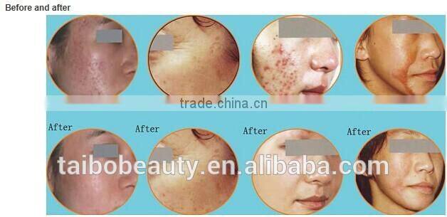 usa TUBE fractional co2 laser scar wrinkle removal machine vaginal laser beauty salon equipment supplier