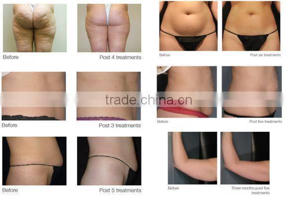 New Product Single Handle Cavitation Slimming Machine