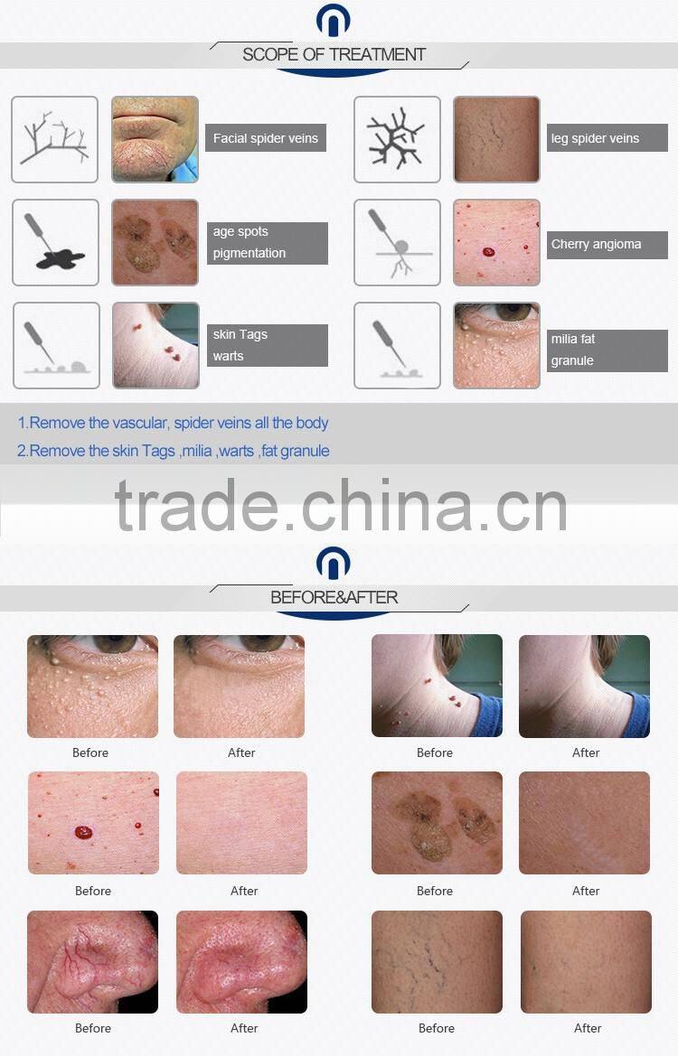 30MHz high frequency spider vein removal machine laser vascular spider vein removal