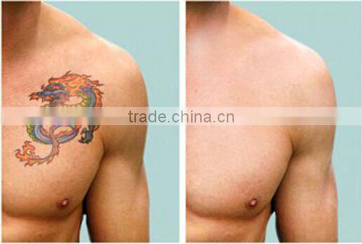 2016 TOP Quality MIni ND Yag laser machine for tattoo removal/tattoo anesthetic tattoo removal laser machine