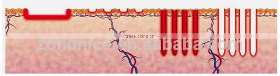 ER600C newes fractional co2 laser scar removal machine