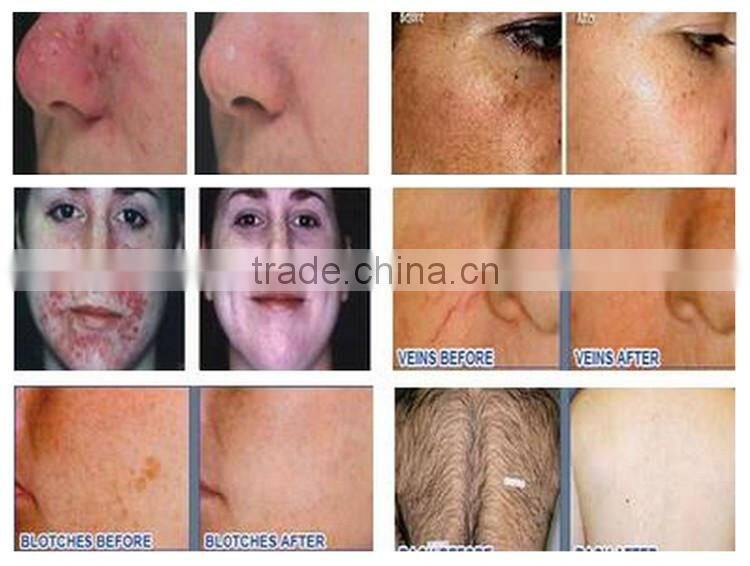 Factory Price!!! New Design Advanced clinic ipl machines for hair removal