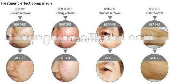 GL-03 Portable IPL Beauty Equipment for skin treatment and hair removal