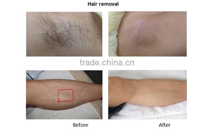 95000 shots replaceable laser flash lamp ipl photofacial machine laser hair removal machine diode