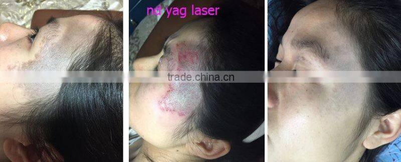 2017 Professional OPT Type Q Switch ND Yag Laser tattoo removal machine for sale
