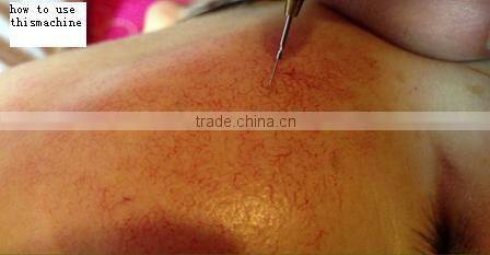 spider vein removal machine