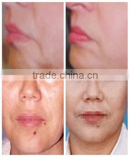 rf radio frequency skin tighten and wrinkle removal
