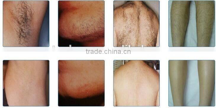 vertical professional SHR IPL/ 10Hz painless opt hair removal machine