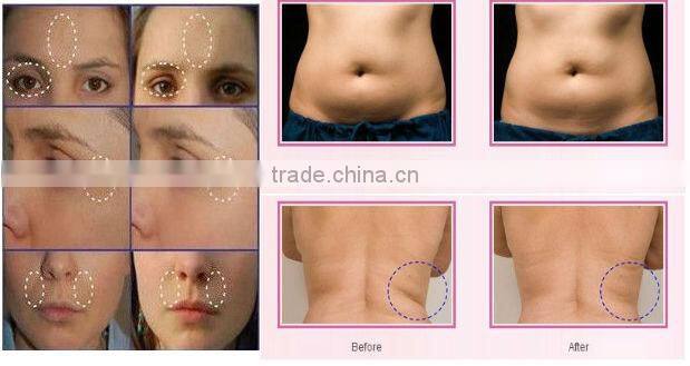 professional rf face lifting machine