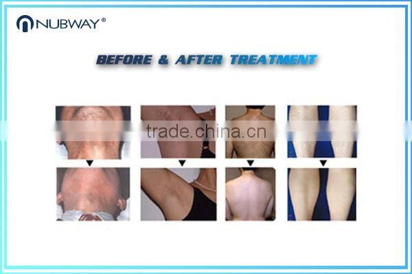 Laser Hair Removal 20*12 big spot 808nm Diode Laser hair Removal