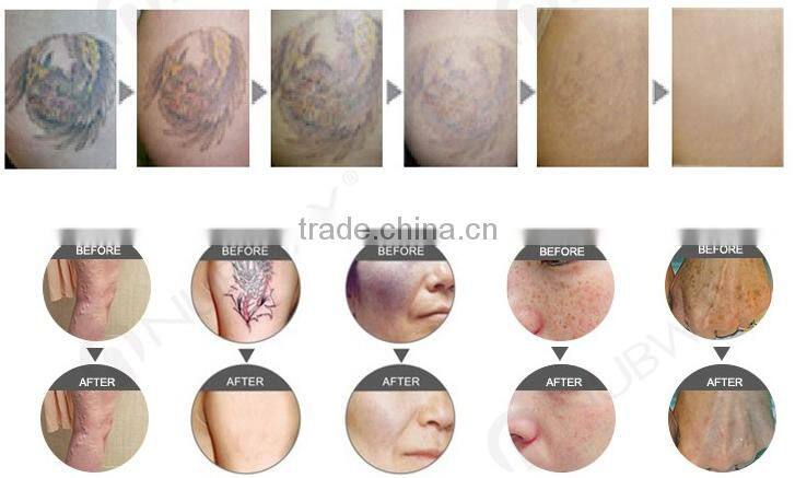 Best q-switched nd yag laser tattoo pigment removal equipment /q-switched laser skin rejuvenation machine
