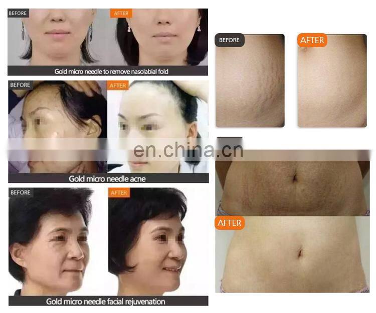 rf microneedling machine portable fractional rf microneedling microneedling for the body