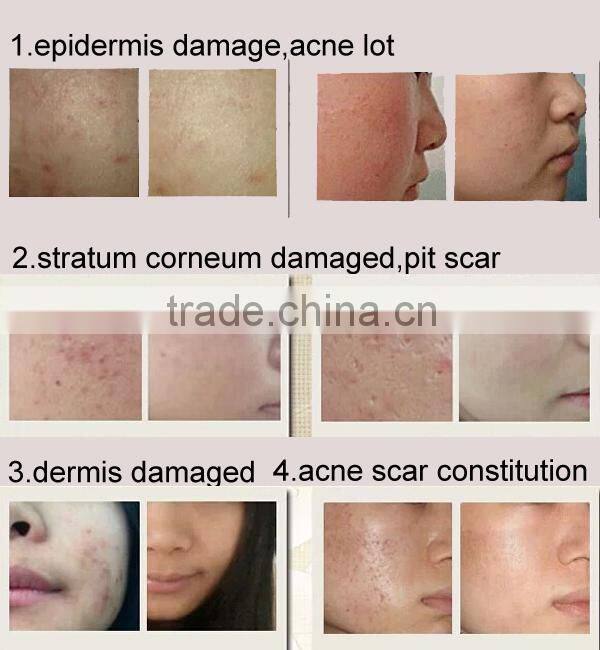 DNS BioGenesis Anti Aging Skin Rejuvenation Microneedles Therapy Device 2.0mm Needle Derma Skin Roller