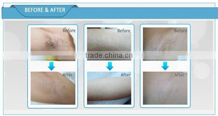 Beauty Salon Hot Sale 2015 Summer Home Use Portable Permanent Laser IPL Photon Hair Removal Epilator Machine