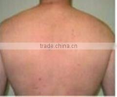 New Product Salon Use Laser Hair Removal Laser Hair Removal E-light IPL