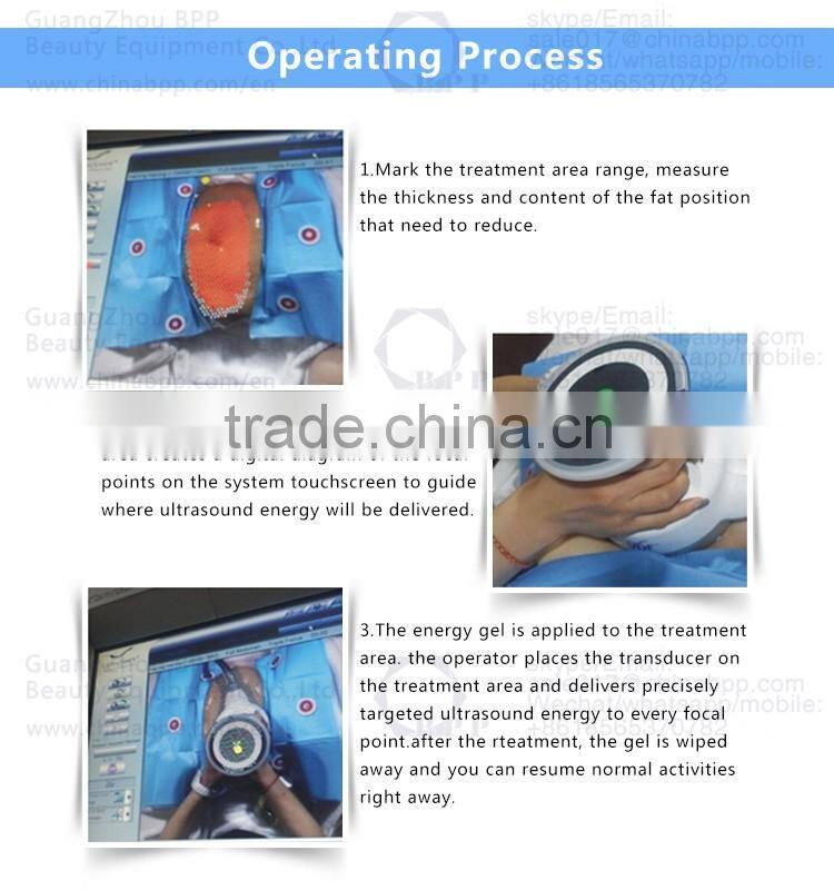 New focused ultrasound ultrashape hifu slimming machine
