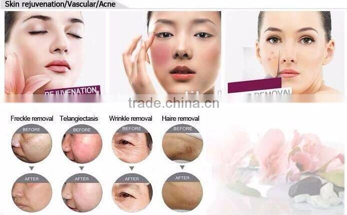 The advanced 3000w power shr hair removal hospital equipment name