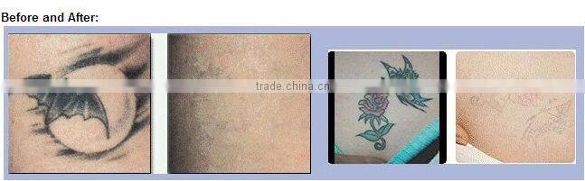 Q Switched nd Yag Laser for tattoo removal/ tattoo removal machine for sale/ laser beauty equipment