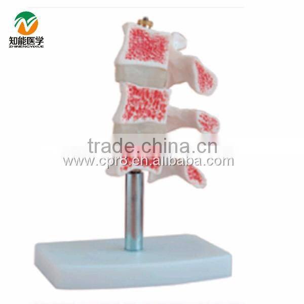 BIX-A1015 Human osteoporosis anatomical Model (3 vertebrae)