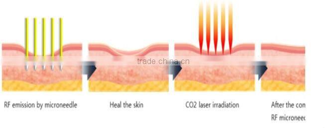 skin renewal micro needle fractional rf laser acne removal machine