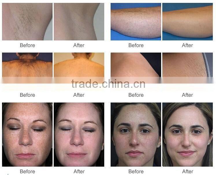 portable ipl hair removal machine