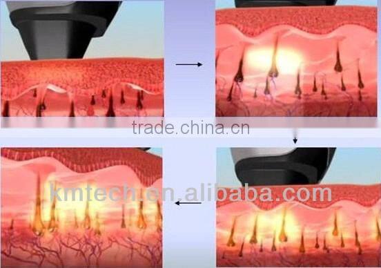 professional dilas 808nm diode laser hair removal machine