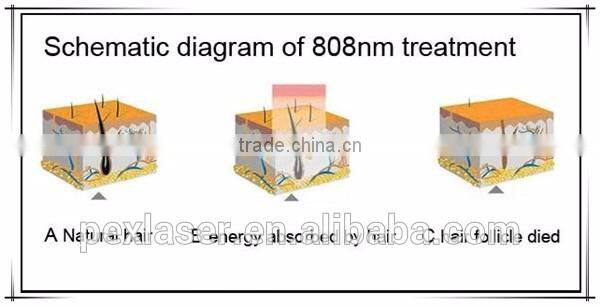 2016 808 nm laser diode portable hair removal