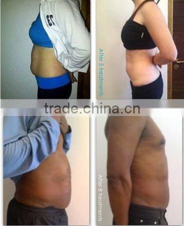 cellulite reduction lipo laser machine/weight loss products best lipo laser machine