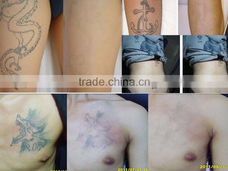 2014 Portable salon home use CE TUV approved mini laser skin spot removal machine