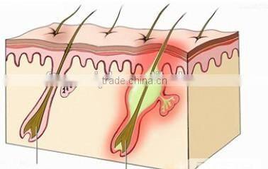 Professional Cosmetic Elight Skin Rejuvenation plus 808nm Diode Laser beauty equipment