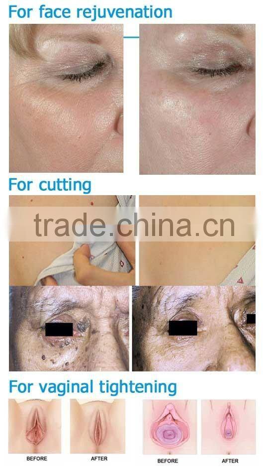 Hottest Design 10600 nm Laser co2 fractional for vaginal tightening