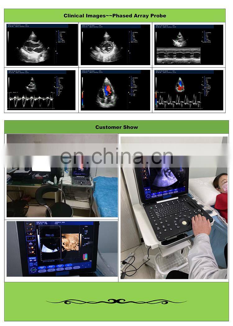 HC-A012F Ultrasound Scanner The Most Economical Portable Color Doppler Ultrasound Scanner color doppler ultrasound machine