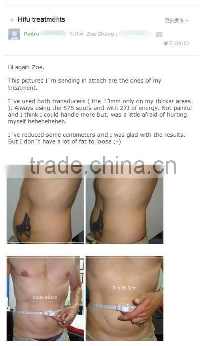 Best Hifu ultrasound machine /hifu slimming equipment