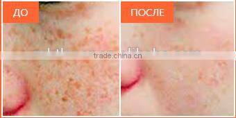 MBT LASER shr ipl Professional Multifunction digital permanent hair removal skin rejuvenation opt machine