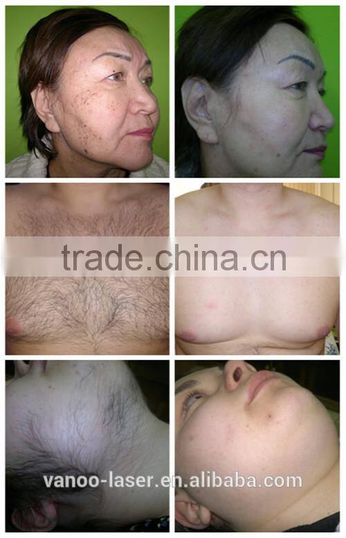 Portable Skin Rejuvenation Vascular Removal Elight Hair Removal Machine
