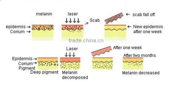 KES High Power Q switched Nd Yag Laser freckle removal permanent Machine
