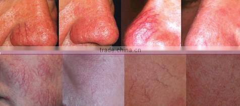 factory price best beauty device / facial veins removal / laser varicose veins treatment