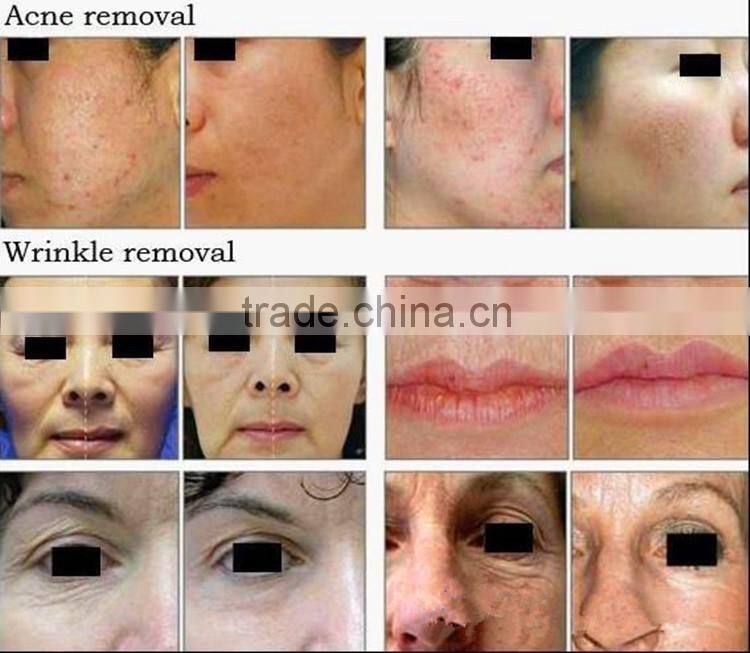 pimple removal machine